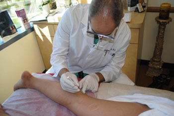 aslera injection varicose spider vein removal ventura